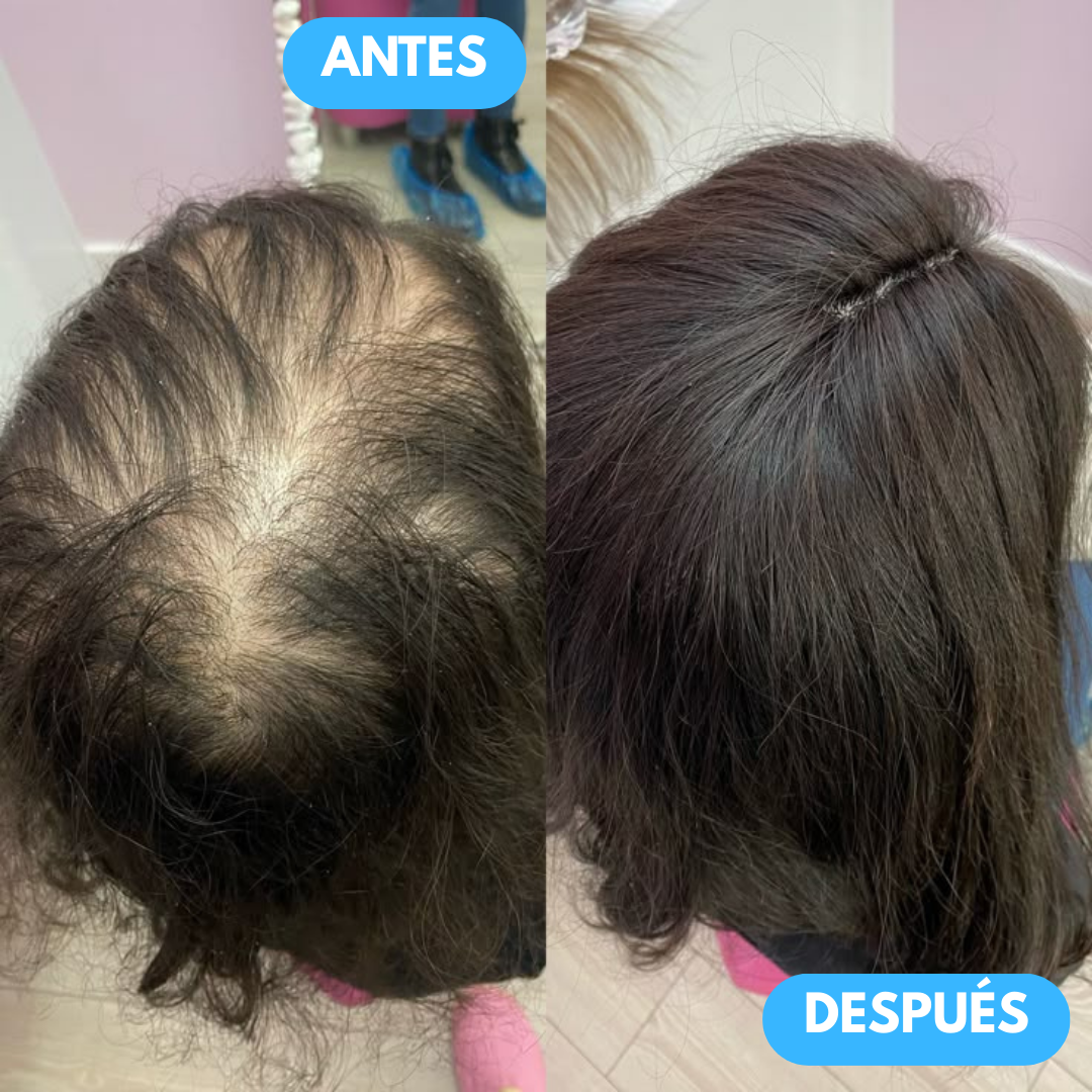 PACK ANIVERSARIO GRATIS | Champú AntiCaída Sovana - Refortalece tu cabello en 7 días
