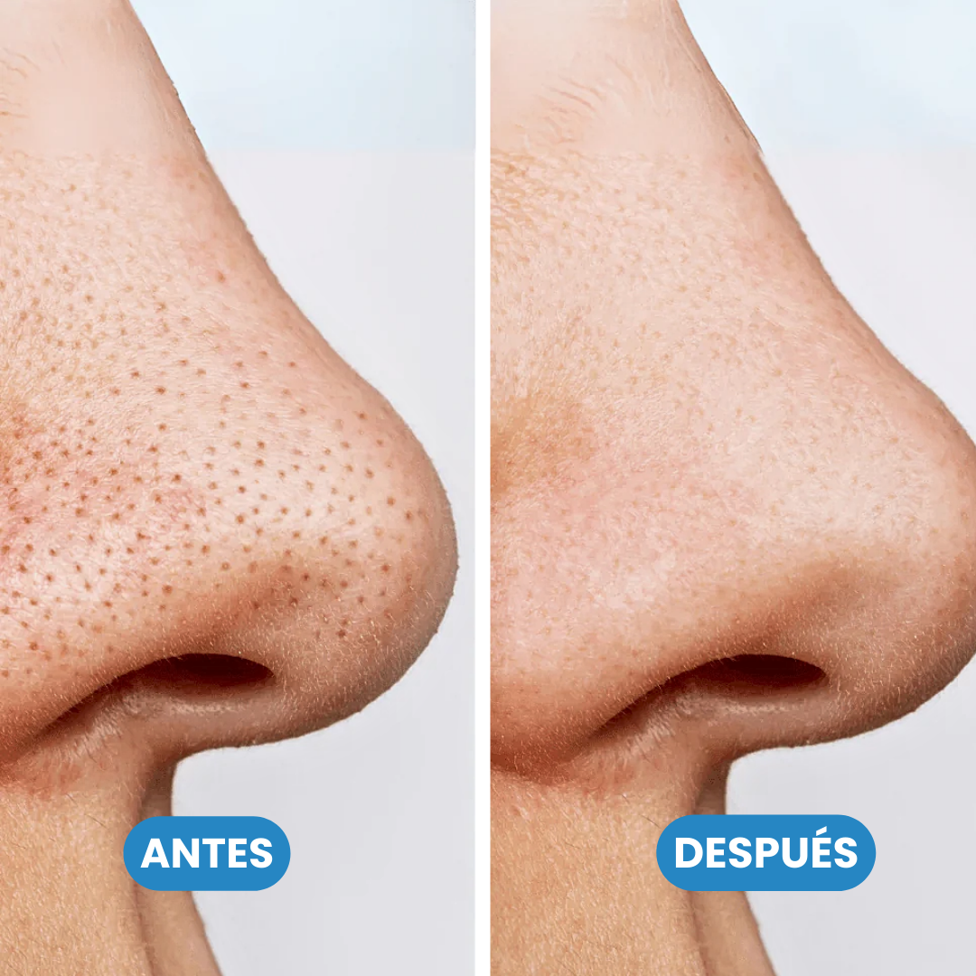 Sovana Anua - El único limpiador eficaz ante los puntos negros