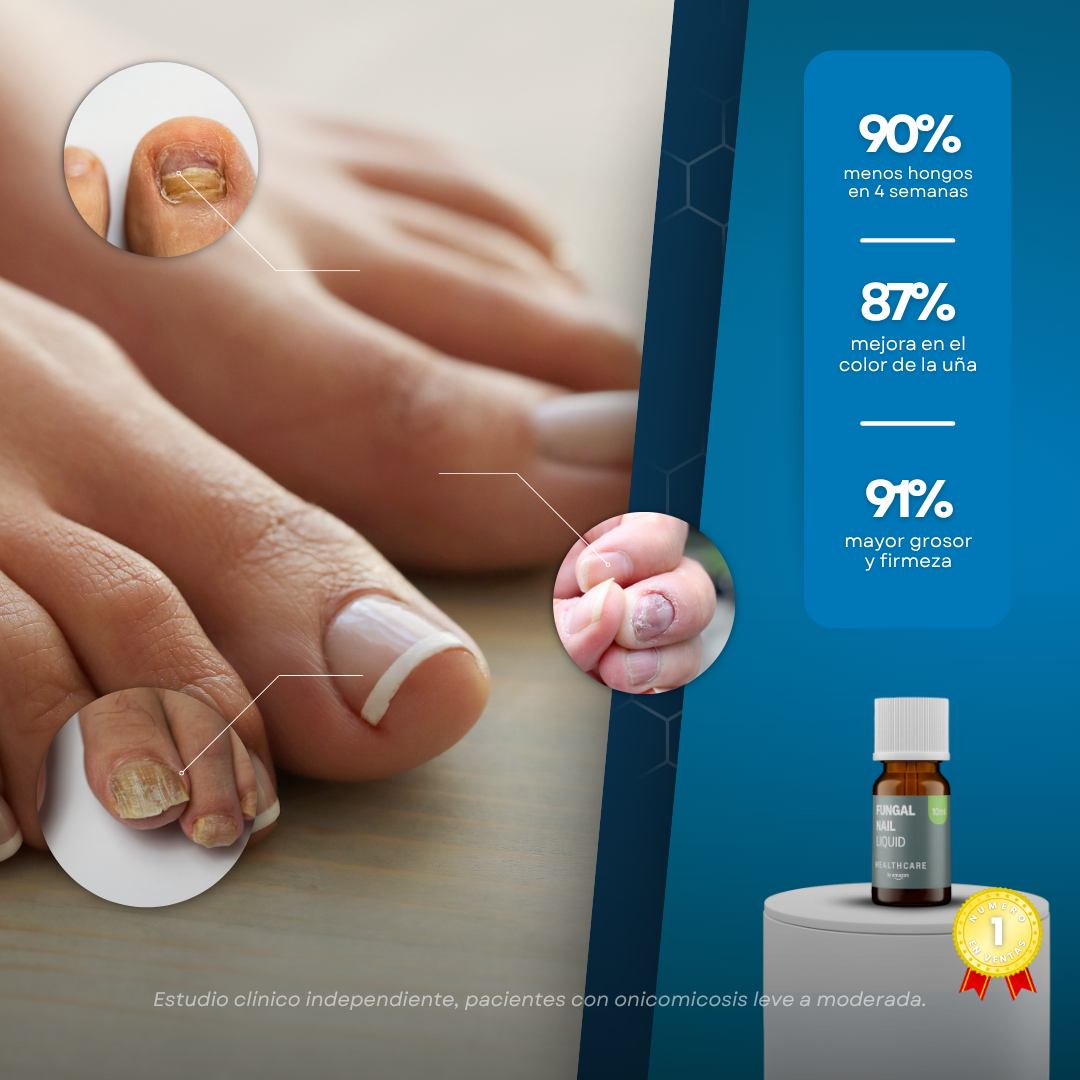 Sanorys Fung - Líquido para eliminar hongos de las uñas