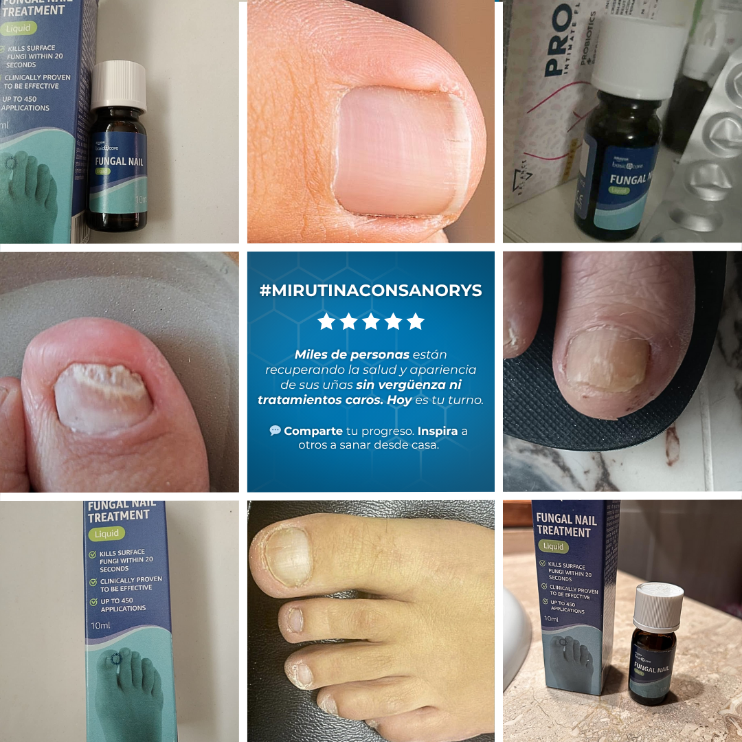 Sanorys Fung - Líquido para eliminar hongos de las uñas